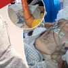Dudley man rebuilds his life after penile cancer forced full reconstruction